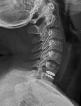 CR_XRAY CERVICAL SPINE_2024-07-08 (2)
