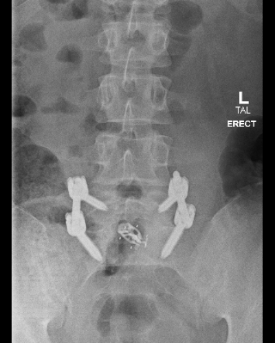 CR_XRAY LUMBOSACRAL SPINE_L-SPINE ERECT AP_OBL_2025-07-18 (1)
