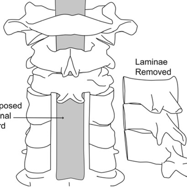 Cervical laminectomy