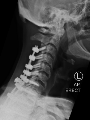 DX_XRAY CERVICO-THORACIC SPINE_AP OPEN MOUTH_2020-08-13