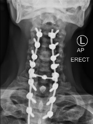 DX_XRAY CERVICO-THORACIC SPINE_AP_2020-08-13