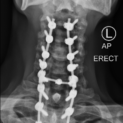 DX_XRAY CERVICO-THORACIC SPINE_AP_2020-08-13