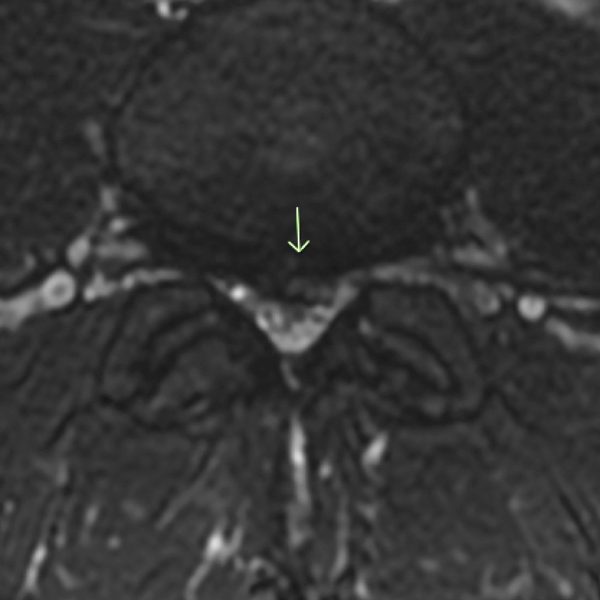 MRI T2 Ax