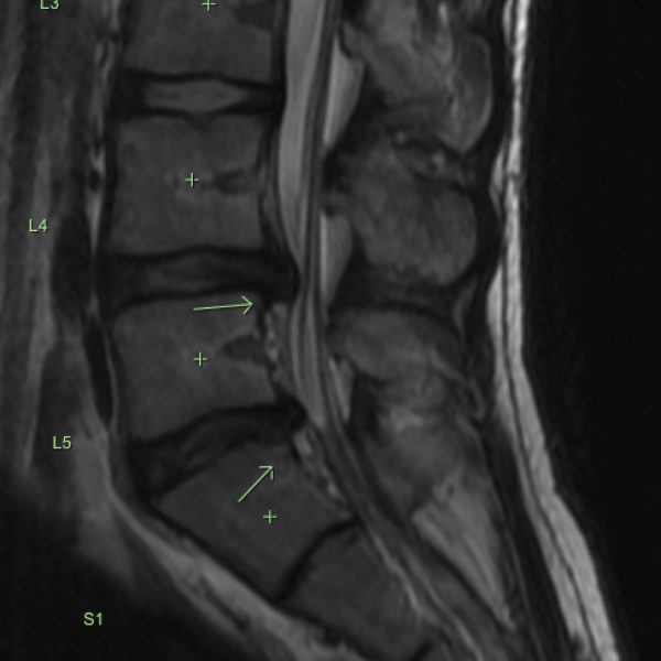 MRI T2 Sag