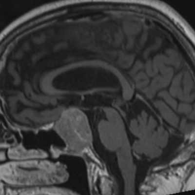 MR_MR BRAIN STEREOTAXIS+C_T1_SPC_TRA_P2_ISO_0.9MM +C_MPR_SAG_2022-07-18
